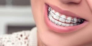 pemasangan kawat gigi, bahaya pasang kawat gigi, pasang behel
